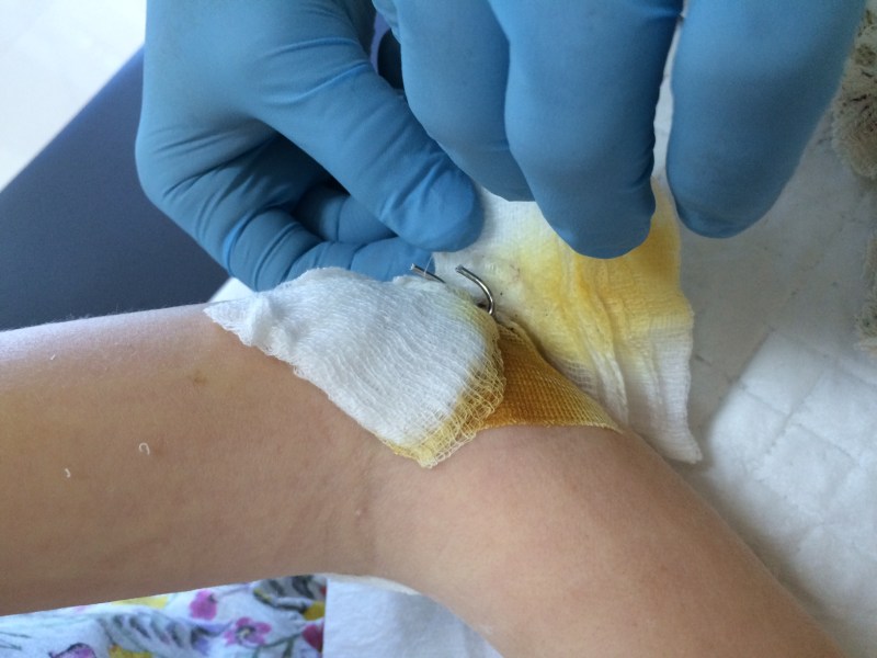 Cilles brækkede albue 18