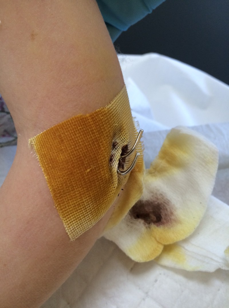 Cilles brækkede albue 19