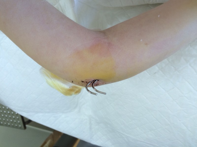 Cilles brækkede albue 20